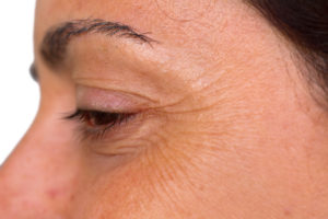 Crows Feet wrinkle treatment