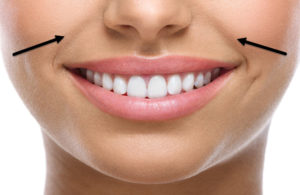 Nasolabial smile line treatments in Bristol.