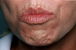 Wrinkly Chin Treatment Bristol