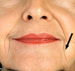 Marionette wrinkle filler treatments in Bristol.