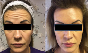 Forehead wrinkle injection before and after