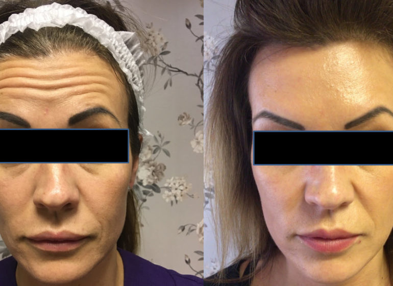 Forehead wrinkle injection before and after
