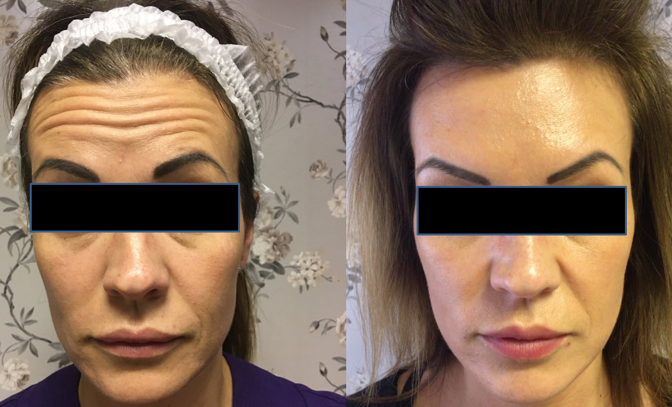 Botulinum Toxin: Before And After Photos