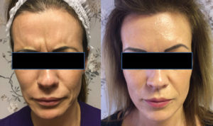 Frown lines before and after injections