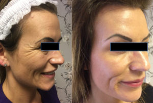 Smile line injections: before and after photos