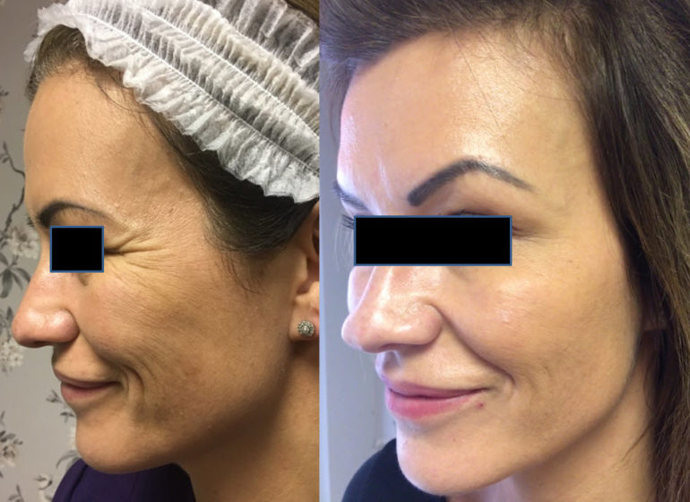 Crow’s feet injections Dr Brad's Clinic