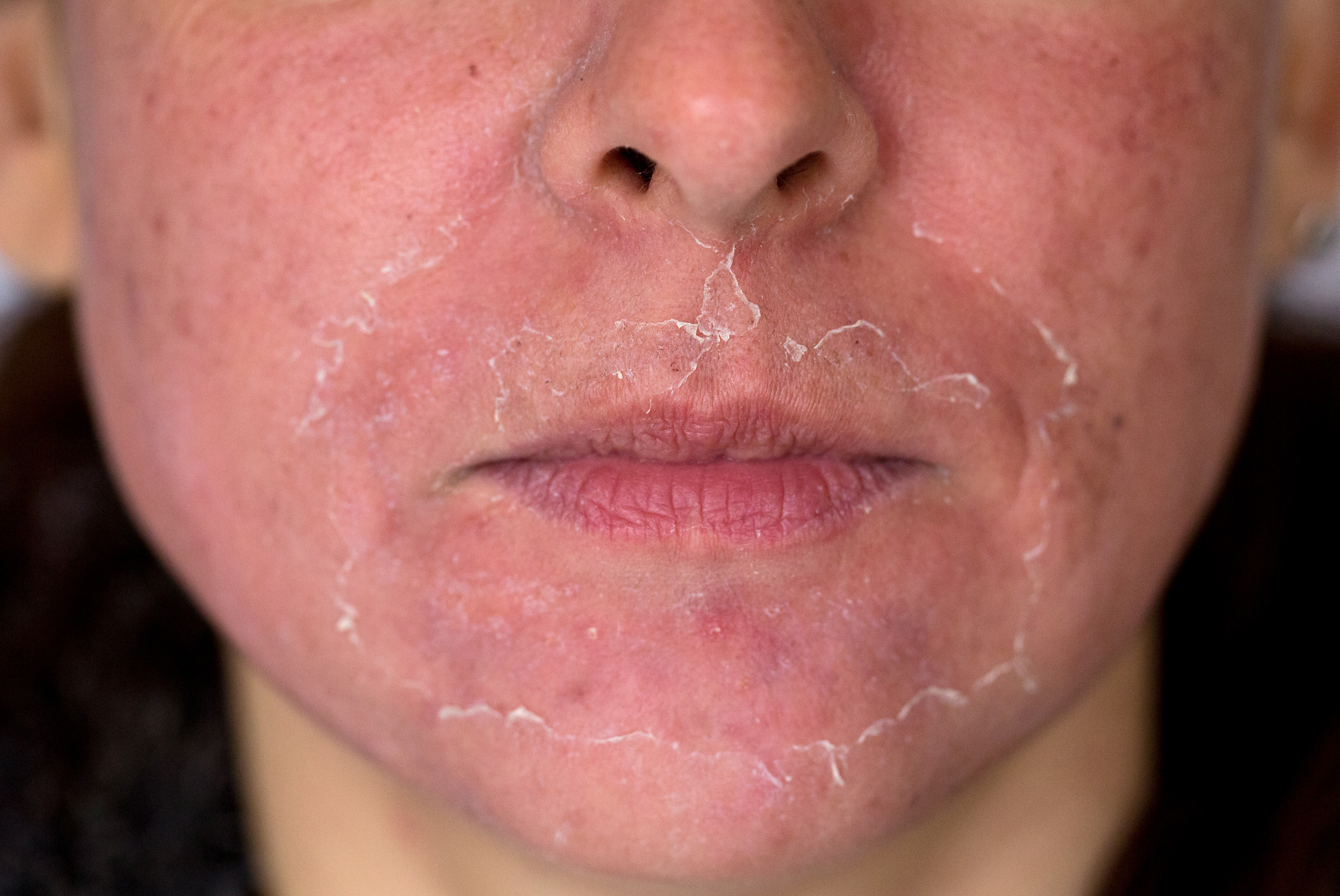 Post-chemical peel facial peeling