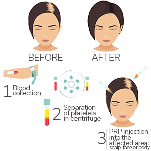 PRP process