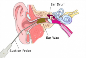 microsuction explained in Bristol