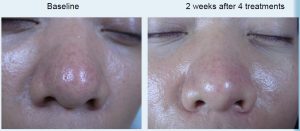 Before and after laser for nasal pores and redness