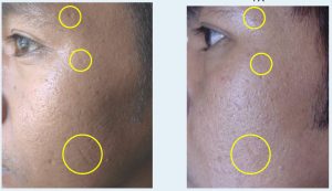 Before and 2 weeks after 3rd laser treatment for acne and pox scarring.