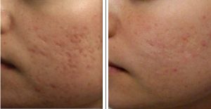 Before and 8 months after 4 laser treatments.