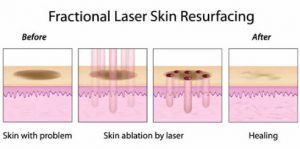 Fractional laser treatment.