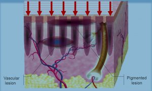 Fractional photothermolysis explained.
