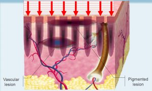 Fractional photothermolysis explained.