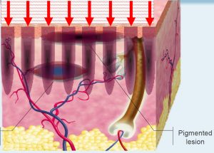 Fractional photothermolysis explained