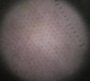 Appearance of the skin as viewed under the magnification of a dermatoscope, demonstrating the superficial micro-epidermal debris .