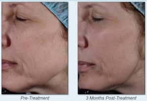 Before and 3 months after laser treatment.
