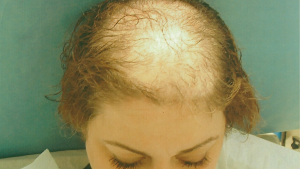 Hair loss treatment in women in Bristol