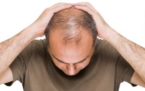 Men's hair loss treatment in Bristol