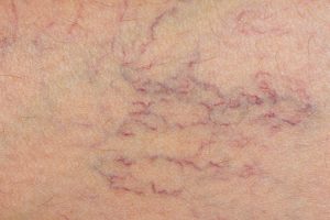 Thread vein treatment Bristol