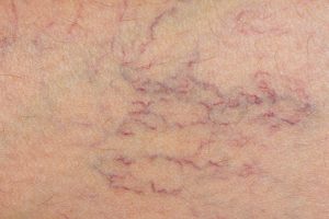 Thread vein treatment Bristol