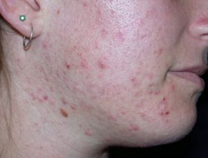 acne bristol