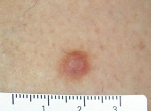 dermatofibroma removal bristol
