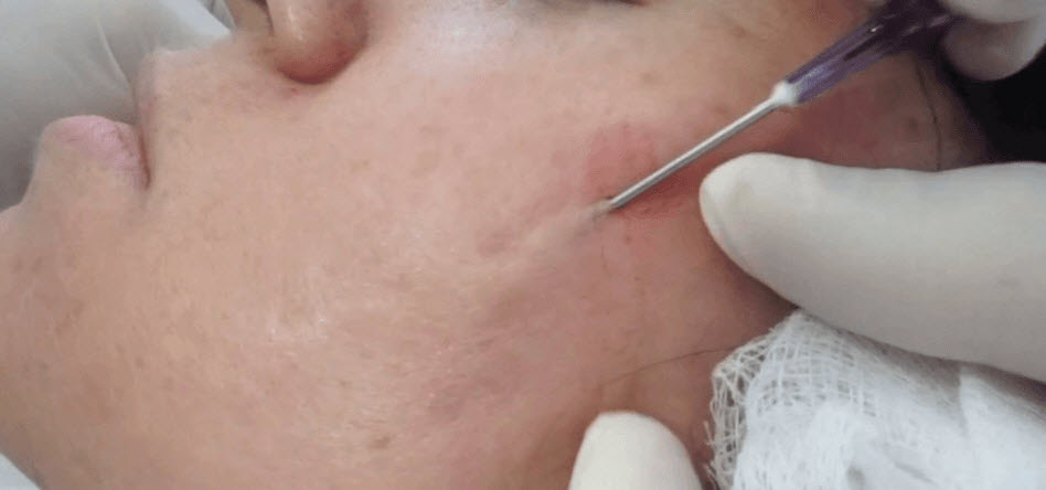 chemical peels bristol