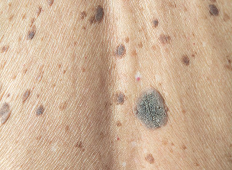 Seborrhoeic Keratosis Dr Brad's Laser and Cosmetic Clinic, Bristol
