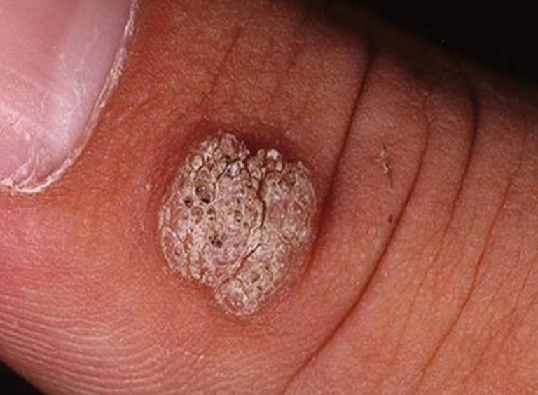 Warts And Verruca Removal Dr Brad s Laser And Cosmetic Clinic Bristol warts-and-verruca-removal-dr-brad-s-laser-and-cosmetic-clinic-bristol