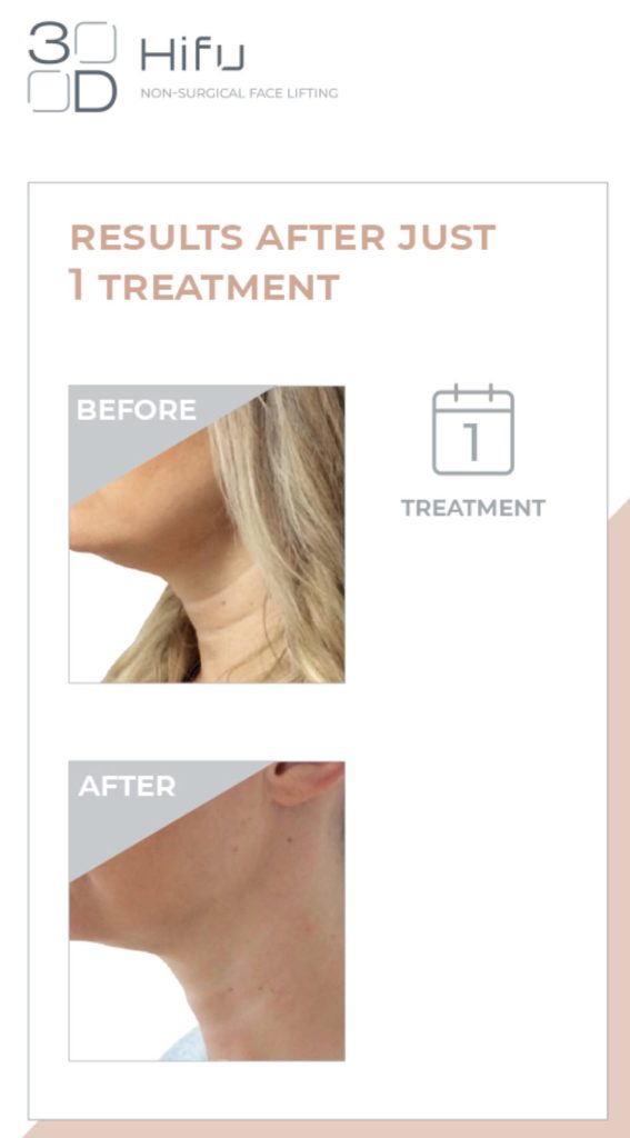 HIFU results