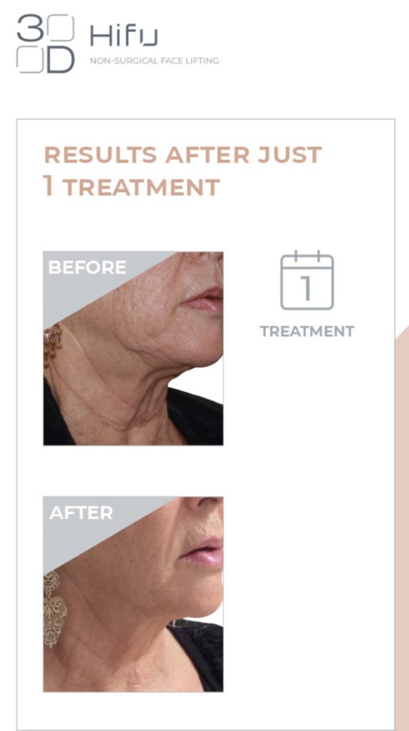 3d hifu results